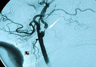 Сужение мозговой артерии, иллюстрация www.hmc.psu.edu